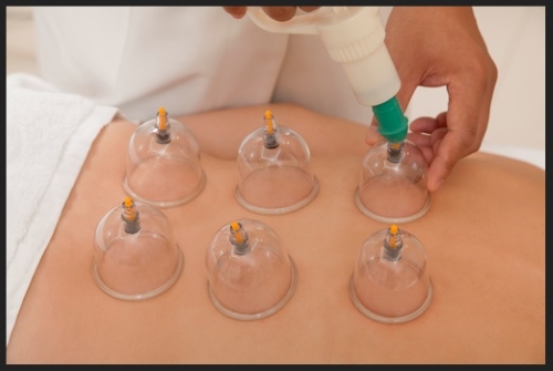 Myofascial cupping therapy applied during a Registered Massage Therapy session at Wrobel Massage Therapy